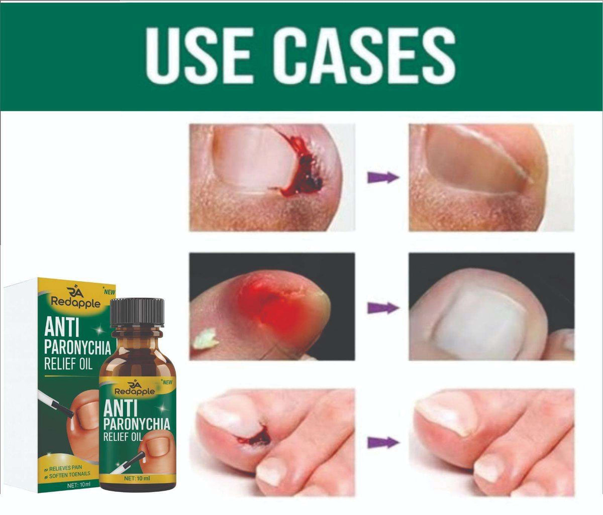 Anti Paronychia Relief Oil 10 ml Pack of 1