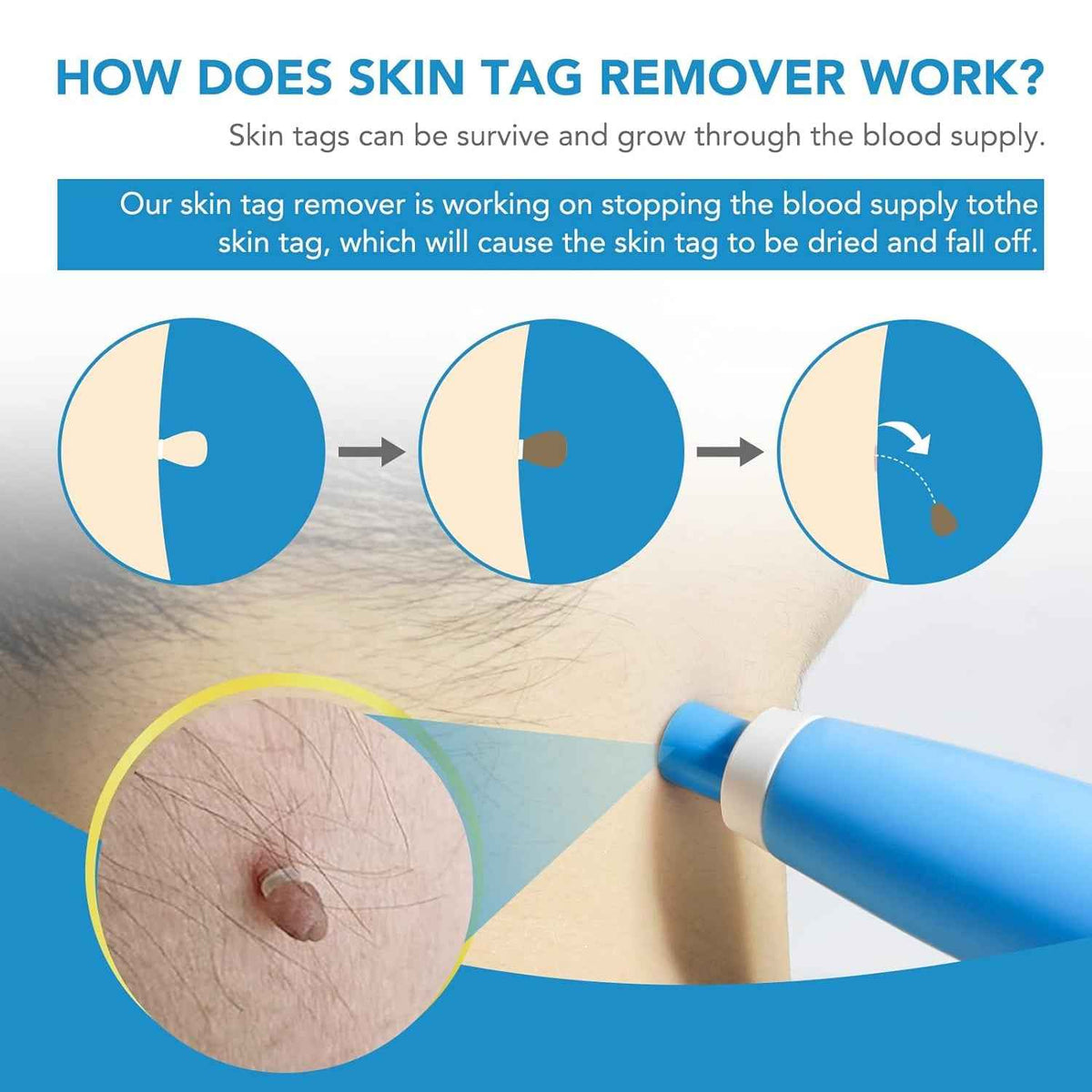 Urban Skin Tag Remover Kit 2 in 1 for Micro to Large (2 mm - 8 mm) - Mr Urban Choices